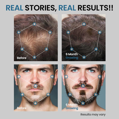 AvitaPure Men’s Minoxidil Hair Regrowth Kit