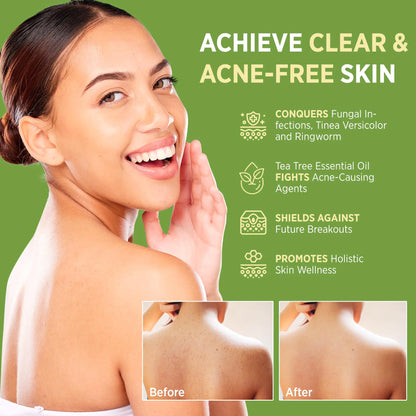 RoyceDerm Tea Tree Oil Antifungal Soap